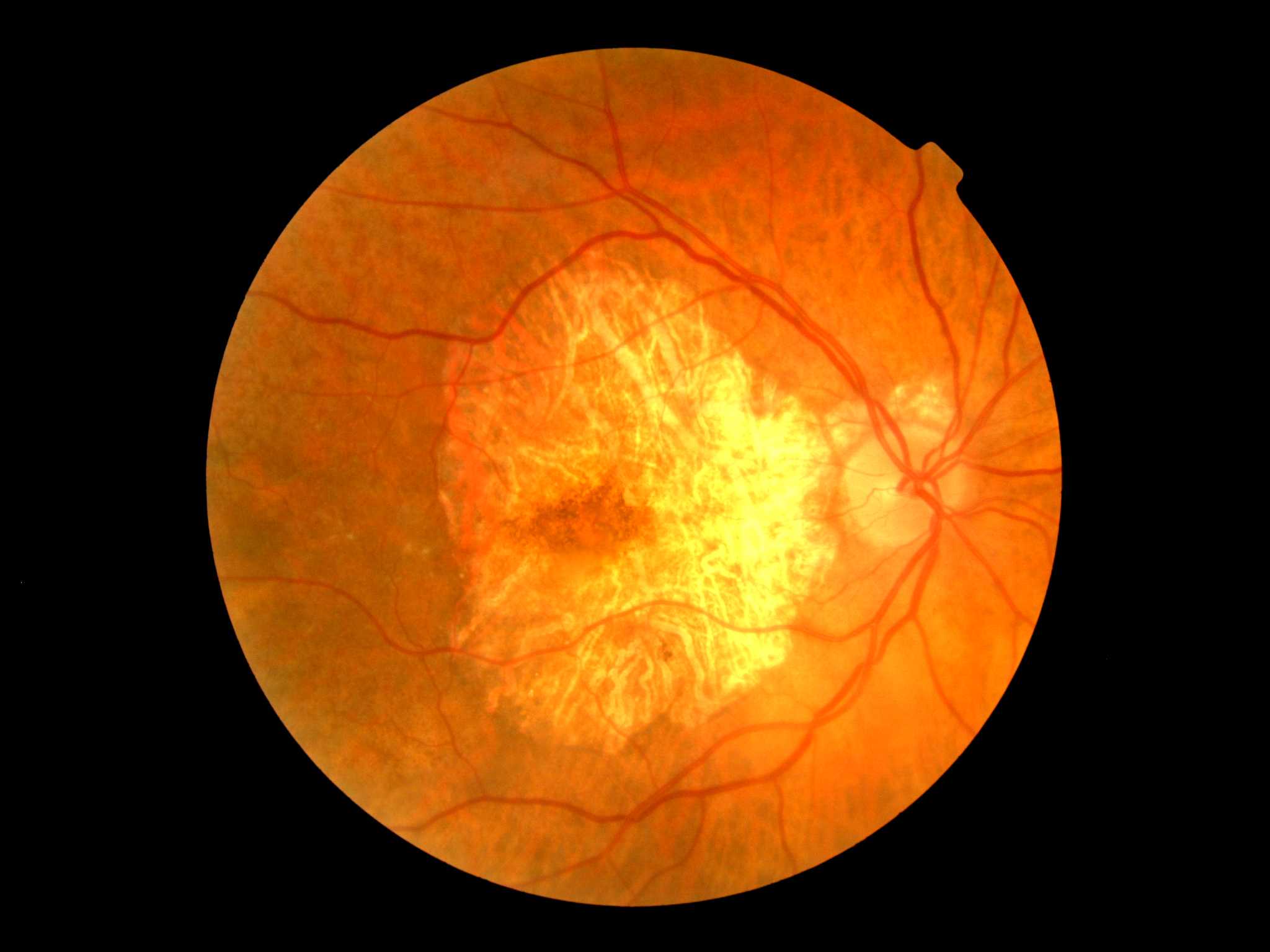 Макулопатия глаза. Макулярная дистрофия сетчатки глаза. Макулодистрофия, макулярная дегенерация; ретинит;. Хориоретинальная дегенерация сетчатки. Возрастная макула дистрофия сетчатки.