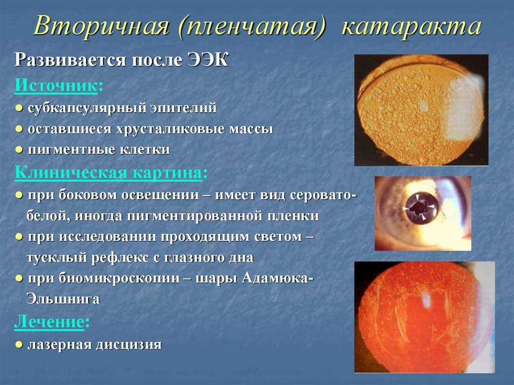 Вторичная катаракта после замены хрусталика: лечение, операция