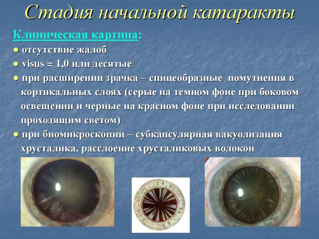 Лечение катаракты у детей