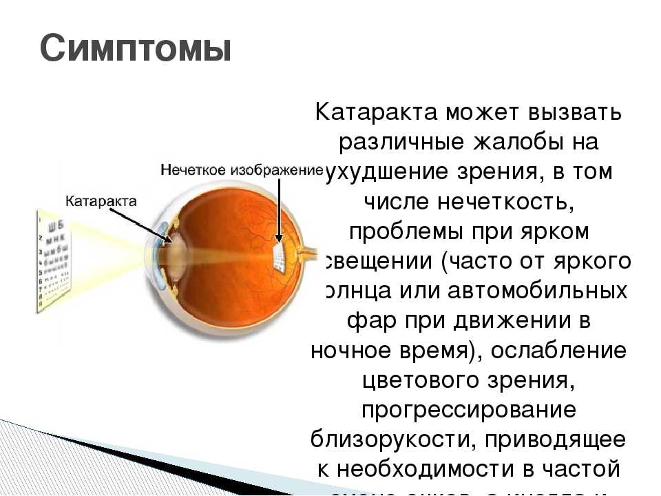 Катаракта глаза: виды, причины возникновения, диагностика, лечение катаракты