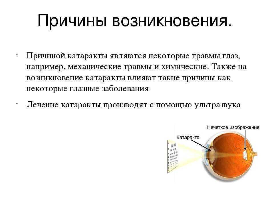 Что такое катаракта: признаки, причины, разновидности, диагностика и лечение - энциклопедия ochkov.net