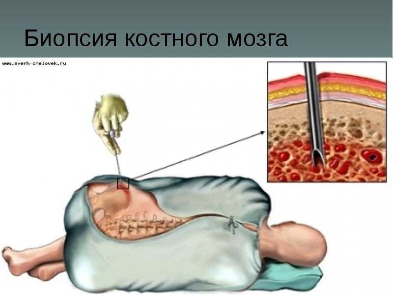 Пересадка костного мозга презентация