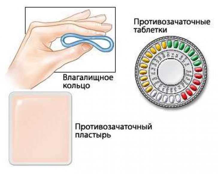 Кольцо как контрацептив